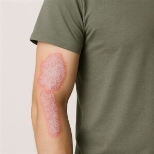 Psoriasis, pikkelysömör – kezelés a PraxisPont Magánegészségügyi Központ bőrgyógyászatán